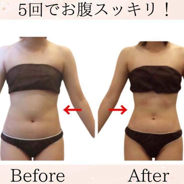 お客様ビフォーアフターお写真　30代　前半お悩みは脚とお腹痩せ　お腹の贅肉と、脚のむくみ太もも全部きになるとゆう事でした。今回は90分コース10回のお腹と脚まるごと施術させていただきました。脚の症例写真は後ほどアップします。見事にお腹くびれができ、体重も5キロ減されました。便秘も解消され腸内環境もよくなりました。当サロンは3つのマシーンを使い分け、自分では落とせないセルライト、部分痩せが可能に！オススメの頻度は最初は週1回ペースを推奨しております。ある程度落ちればその後は施術頻度落としていただいて大丈夫です。体験90分　7800円　お待ちしております。【アクセス】　久留米市本町18-28ミモザ2階　駐車場あり、営業時間　10時〜19時　最終受付　17時半不定休 #久留米　#久留米バストアップ  #久留米バストアップ専門サロン #久留米バスト専門サロン #久留米痩身 #鳥栖エステ #佐賀エステ #佐賀バスト