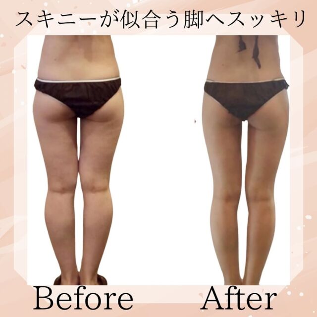脚のセルライトのお悩みの方！お客様　ビフォー、アフター写真30代お客様　70分コース10回3ヶ月でマイナス6キロお悩み　スキニーを履きたい。可愛いい洋服が着たい。脚やせしたい。などお悩み解決！当サロンは3つの異なるマシーンを使用し最速で部分痩せを実感！体験　70分　6800円ご予約お待ちしております。#久留米　#久留米バストアップ  #久留米バストアップ専門サロン #久留米バスト専門サロン #久留米痩身 #鳥栖エステ #佐賀エステ #佐賀バスト