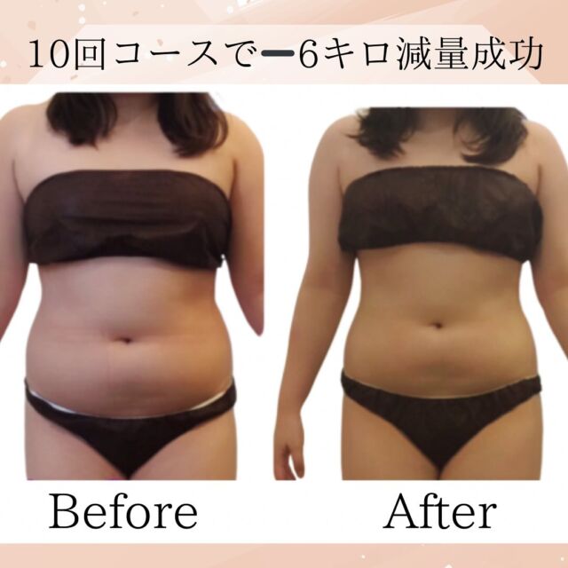 お客様ビフォーアフター写真施術回数10回コース　お腹、背中、二の腕体重は6キロ減量、体脂肪32.2%から27.4%ダウン　健康的に痩せたくダイエット頑張って頂きました。ぽっこり硬い脂肪もサイズダウン！くびれができました！70分体験6800円90分体験7800円部分痩せ、自分ではどうしても落ちない身体ボディメイクしたい方、ダイエットしたい方は是非当店へお任せください。【アクセス】　久留米市本町18-28ミモザ2階　駐車場あり、営業時間　10時〜19時　最終受付　17時半不定休 #久留米　#久留米バストアップ  #久留米バストアップ専門サロン #久留米バスト専門サロン #久留米痩身 #鳥栖エステ #佐賀エステ #佐賀バスト #痩身久留米