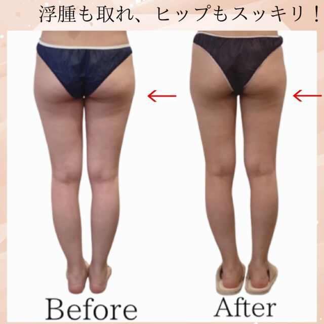 本日は脚でお悩みのお客様のビフォー　アフターの紹介です。30代お客様70分✖️10回コース　施術箇所　脚、ヒップ〜ふくらはぎお尻もスッキリし、綺麗な美脚になりました。脚痩せの方は、是非当店へお任せください。体験70分　6800円【アクセス】　久留米市本町18-28ミモザ2階　駐車場あり、営業時間　10時〜19時　最終受付　17時半不定休 #久留米　#久留米バストアップ  #久留米バストアップ専門サロン #久留米バスト専門サロン #久留米痩身 #鳥栖エステ #佐賀エステ #佐賀バスト 　#久留米#バストケア#バストアップ#育乳ケア　#おっぱいケア#豊胸久留米